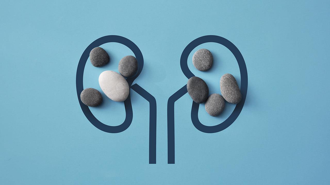 Πέτρες στα νεφρά: Πώς τις προλαμβάνουμε