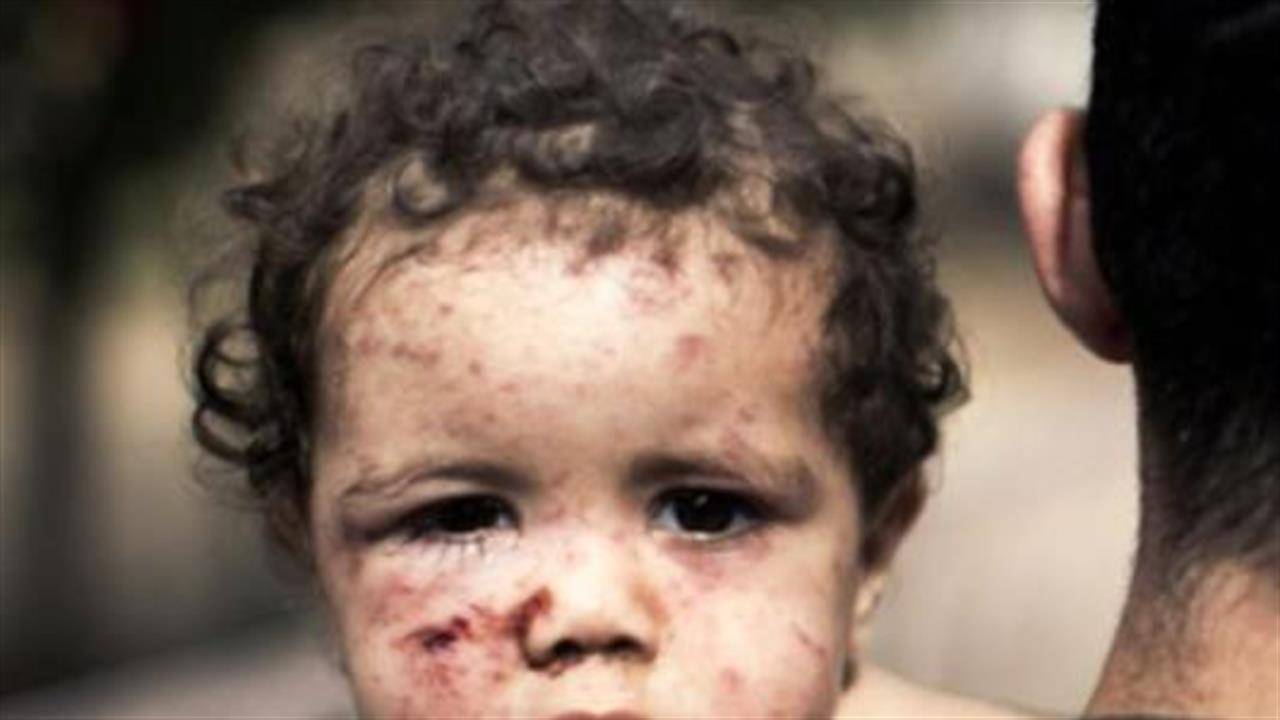 Σε ελληνικά νοσοκομεία τραυματισμένα παιδιά από τη Γάζα