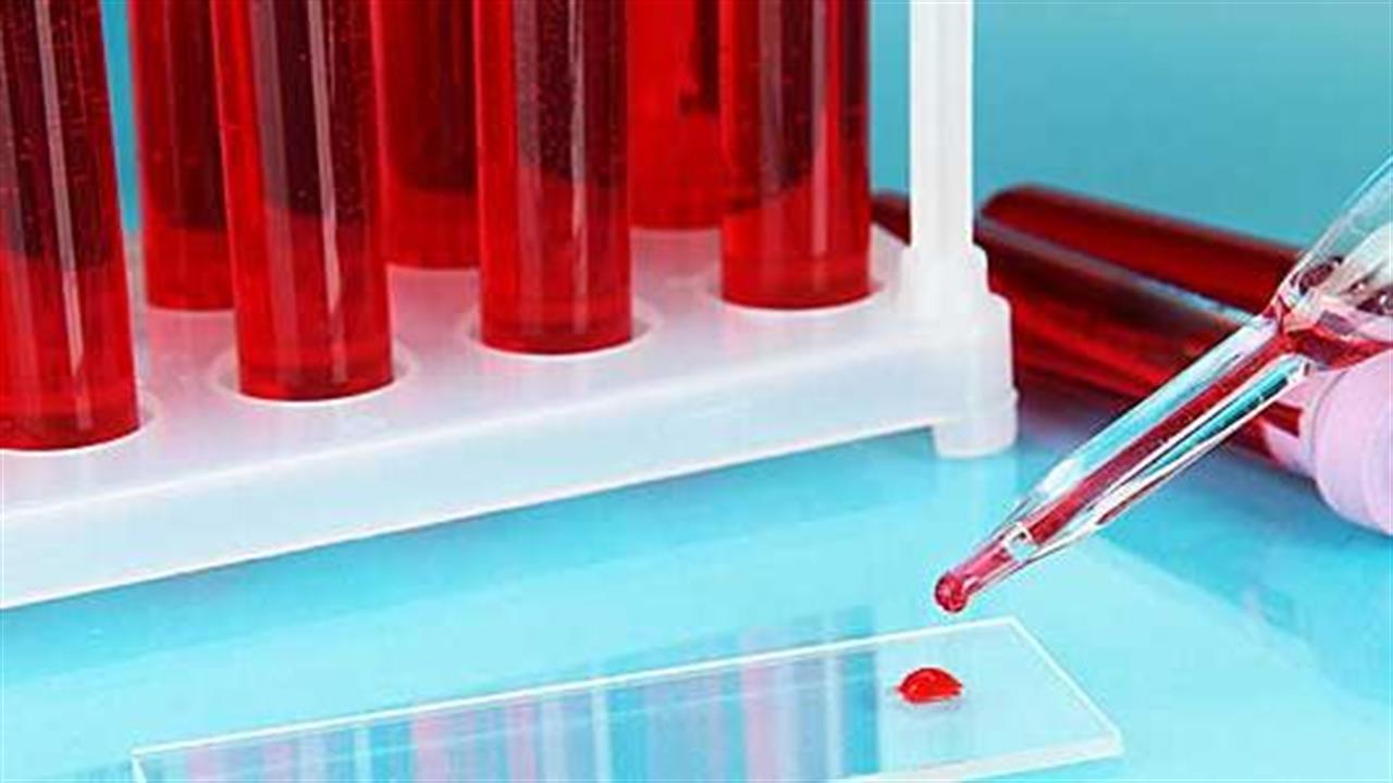 Αναπτύσσεται εξέταση αίματος για την έγκαιρη διάγνωση της οστεοαρθρίτιδας