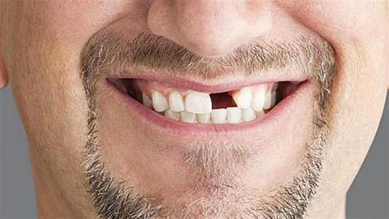 Από απώλεια δοντιών κινδυνεύουν οι καπνιστές