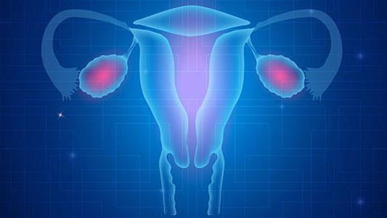 Εξέταση προβλέπει με μεγαλύτερη ακρίβεια τον καρκίνο στις ωοθήκες