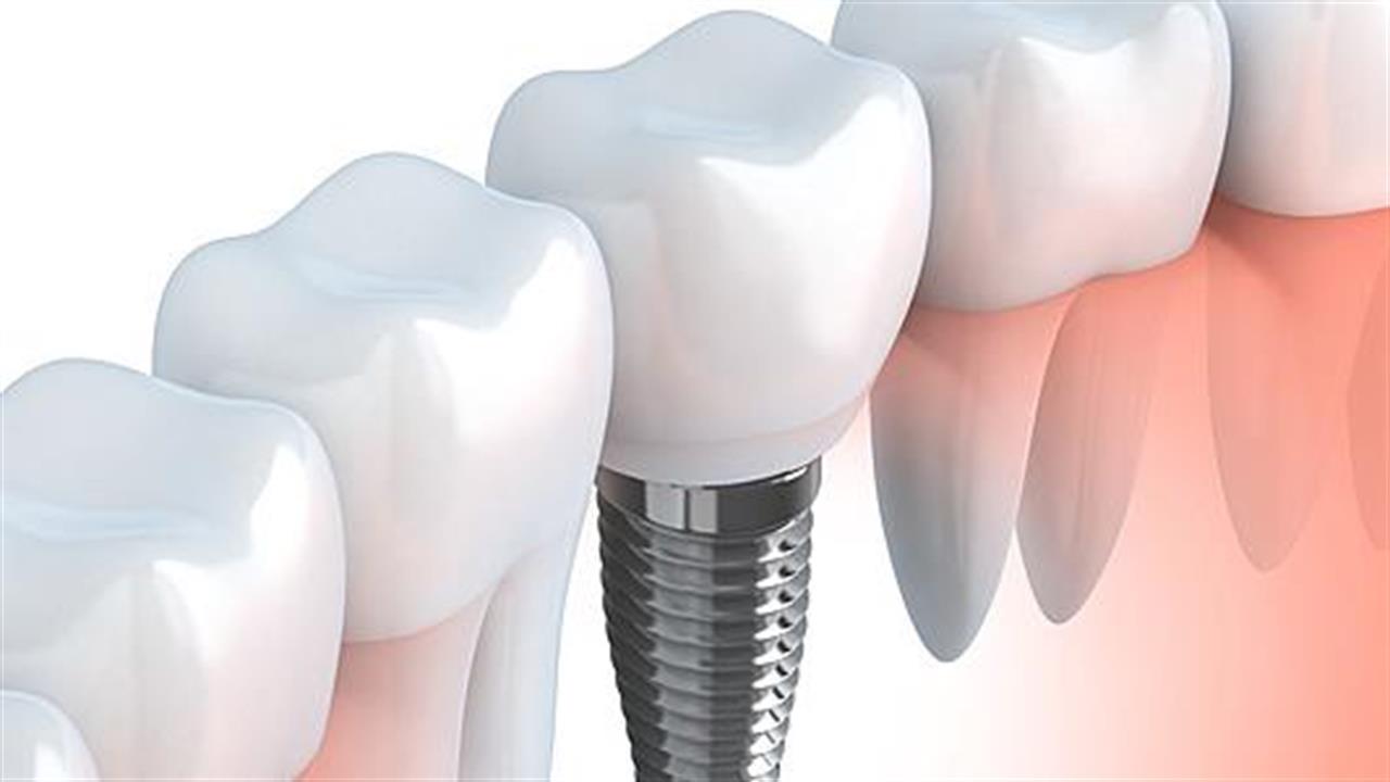 Τι είναι το οδοντικό εμφύτευμα;
