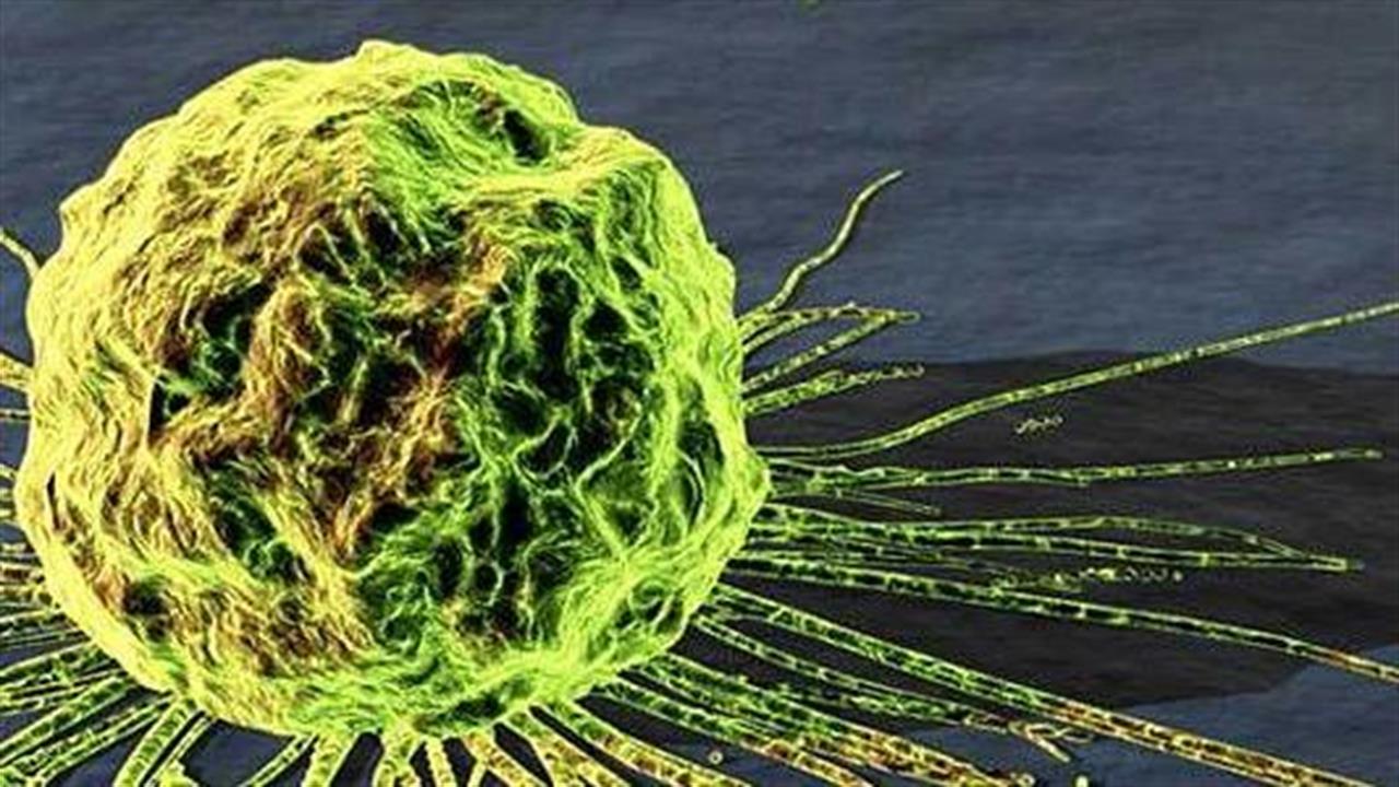 Καρκινικά κύτταρα που πεινούν μπορούν να εμποδίσουν την ανάπτυξη νέων όγκων