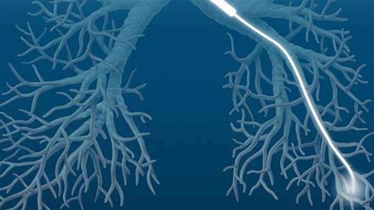 Οι μεσήλικες πιο πιθανό να διαγνωστούν με προχωρημένο καρκίνο στον πνεύμονα