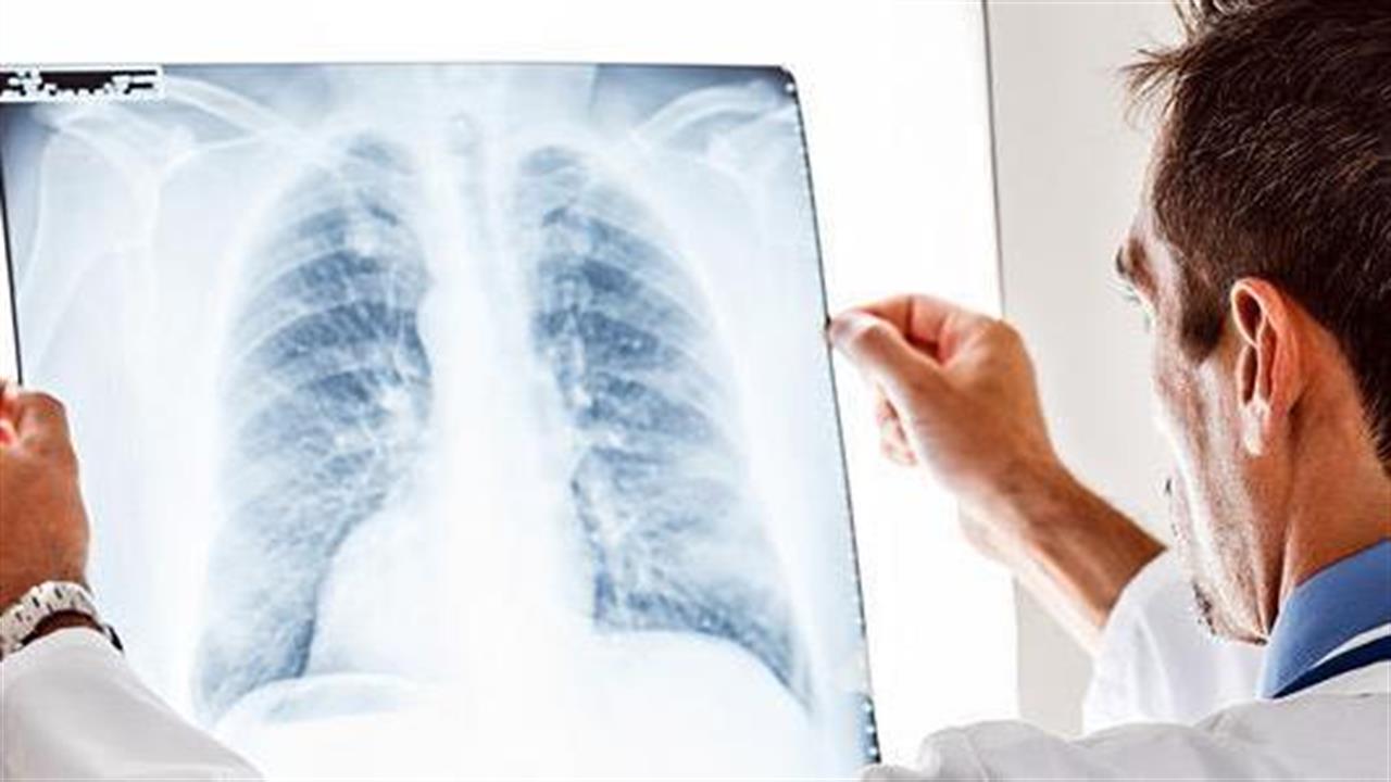 CHMP: Θετική εισήγηση για το pembrolizumab στην αντιμετώπιση του καρκίνου του πνεύμονα