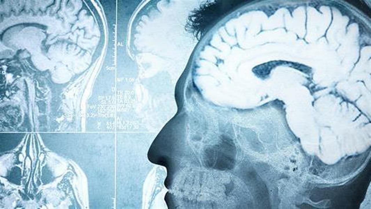Έρευνα: Μακροπρόθεσμες επιπτώσεις από τραυματική εγκεφαλική βλάβη