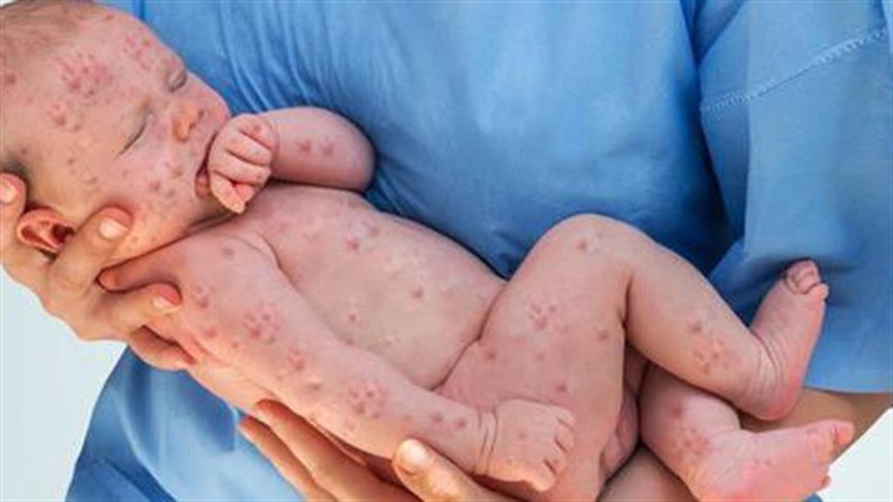 Αυξητική τάση στα κρούσματα ιλαράς – 604 περιστατικά από τον Μάιο – 80 σε μία εβδομάδα