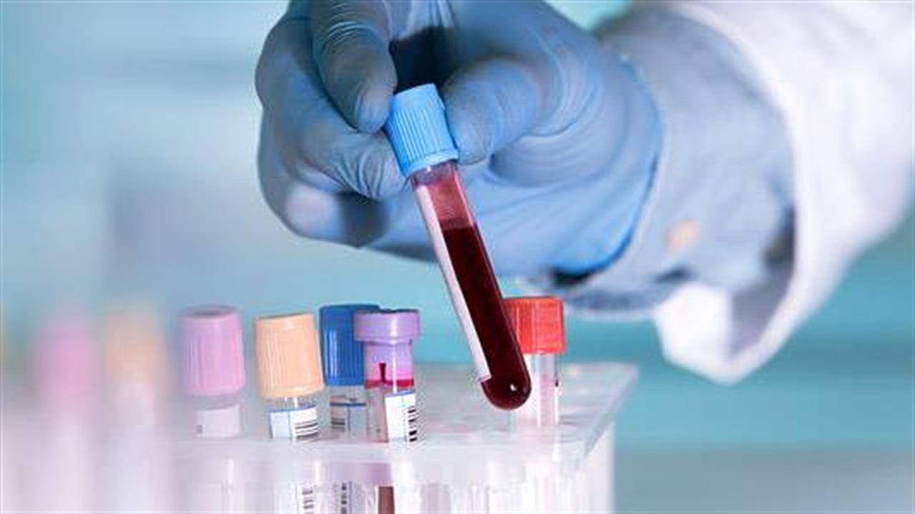 Υποσχόμενη εξέταση αίματος που εντοπίζει 8 είδη καρκίνου