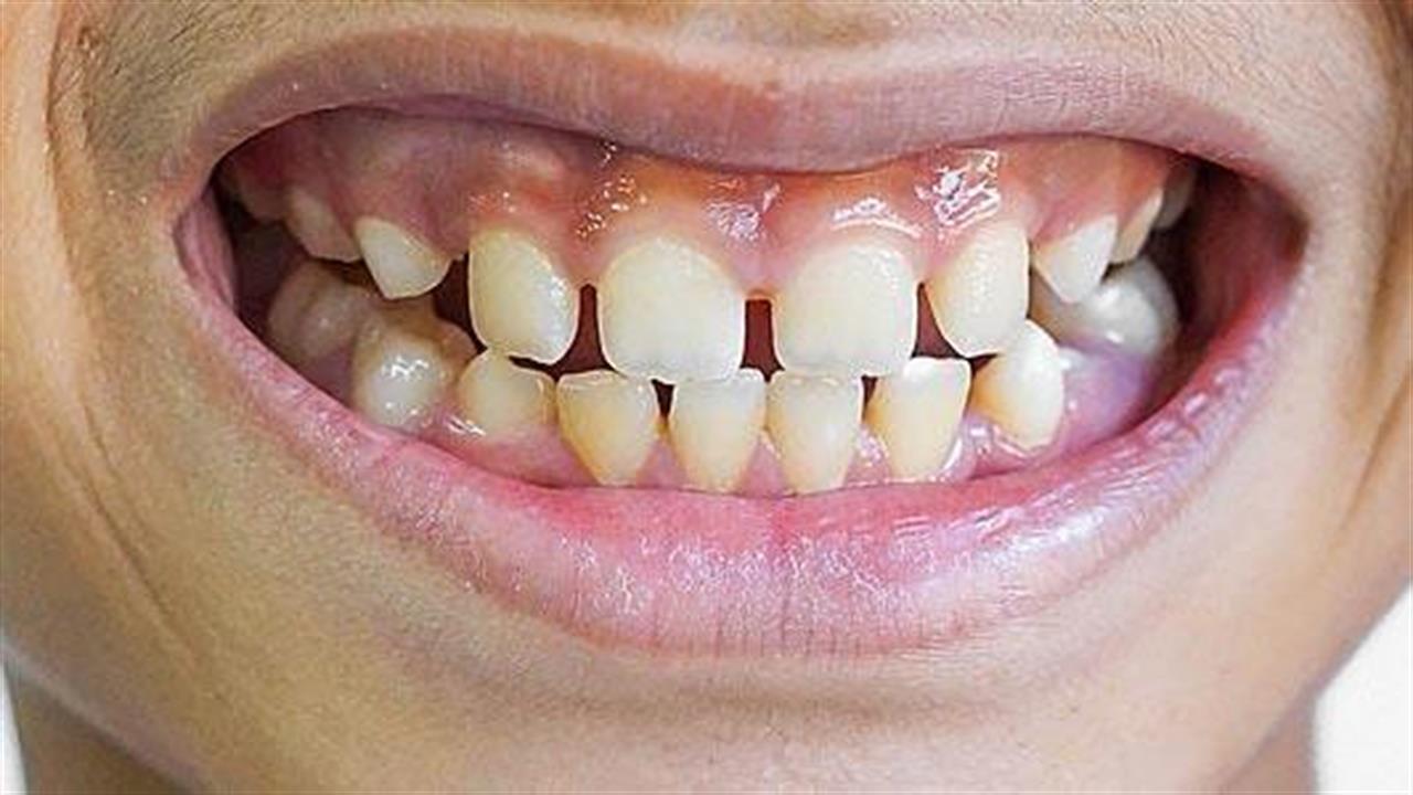 Αραιά δόντια: Πού οφείλεται και πώς αντιμετωπίζεται η έλλειψη δοντιών