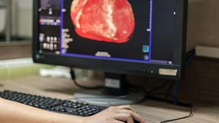 Η τεχνητή νοημοσύνη μπορεί να αξιολογήσει τον καρδιαγγειακό κίνδυνο κατά τη διάρκεια αξονικής τομογραφίας [μελέτη]
