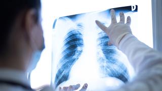 Ραδιοφάρμακο κατά του καρκίνου του πνεύμονα