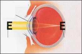 Φυσιολογικός οφθαλμός - Εικόνα που εστιάζεται επάνω στον αμφιβληστροειδή