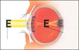 Μυωπικό μάτι - Οι εικόνες αντί να εστιάζονται στον αμφιβληστροειδή προβάλλονται μπροστά από αυτόν