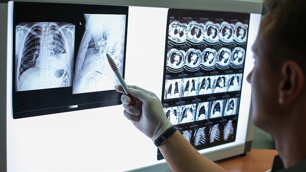 Η MSD Ελλάδος ενημερώνει και ευαισθητοποιεί για τον καρκίνο του πνεύμονα