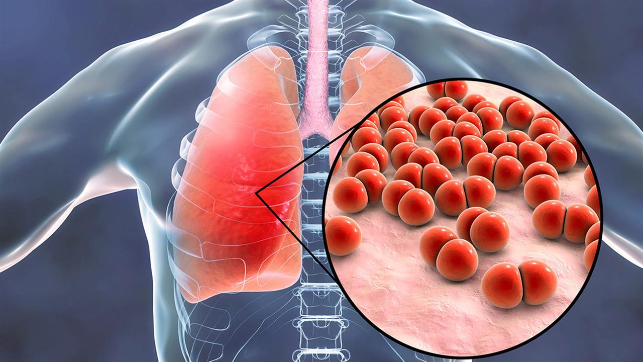 Πνευμονία: Όσα πρέπει να γνωρίζουμε για τη λοίμωξη των πνευμόνων