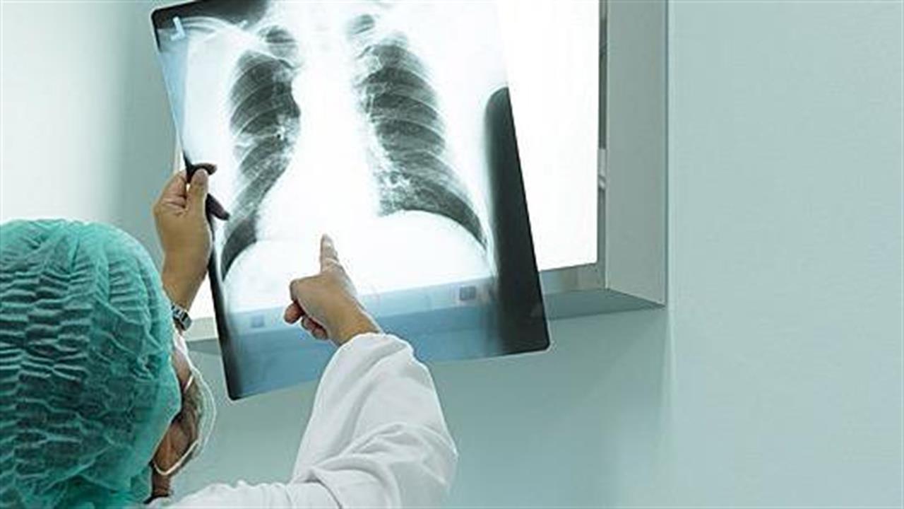 Καταλάβαμε την 4η θέση παγκοσμίως σε νέες διαγνώσεις καρκίνου του πνεύμονα