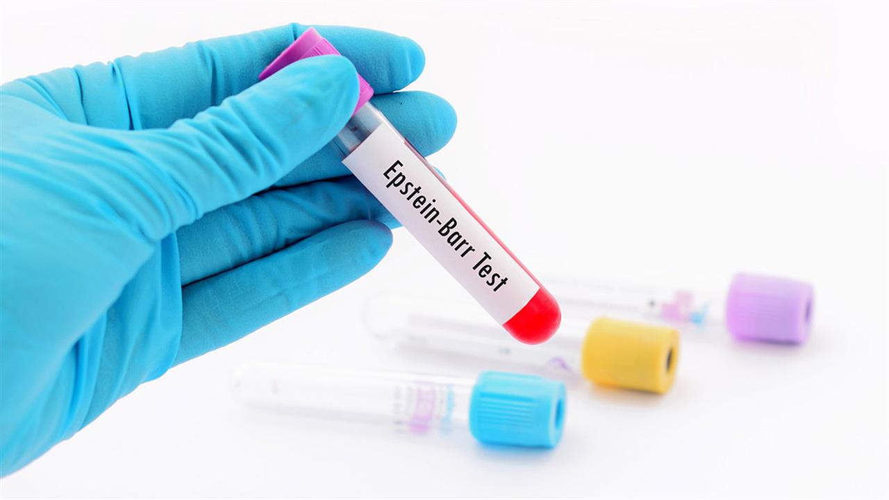‘Ερευνα συνδέει την πολλαπλή σκλήρυνση με λοίμωξη από τον ιό Epstein-Barr