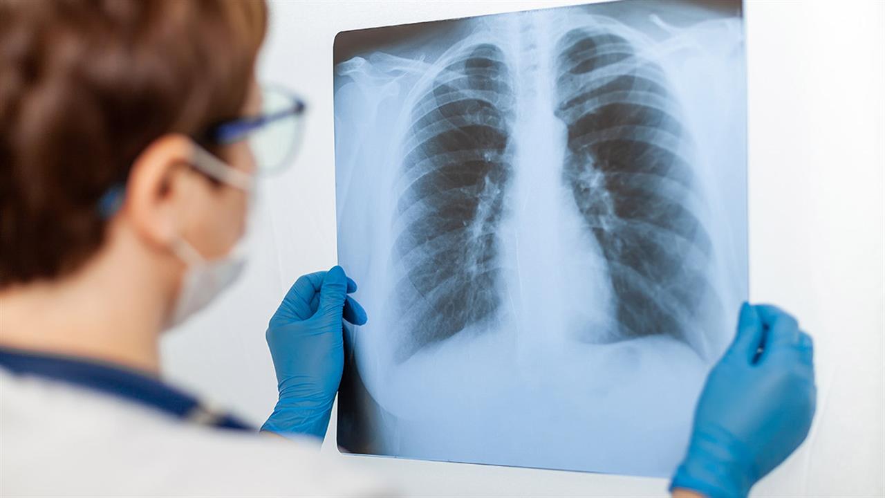 H βλάβη από την COVID-19 ευθύνεται για το 7% των μεταμοσχεύσεων πνευμόνων στις ΗΠΑ