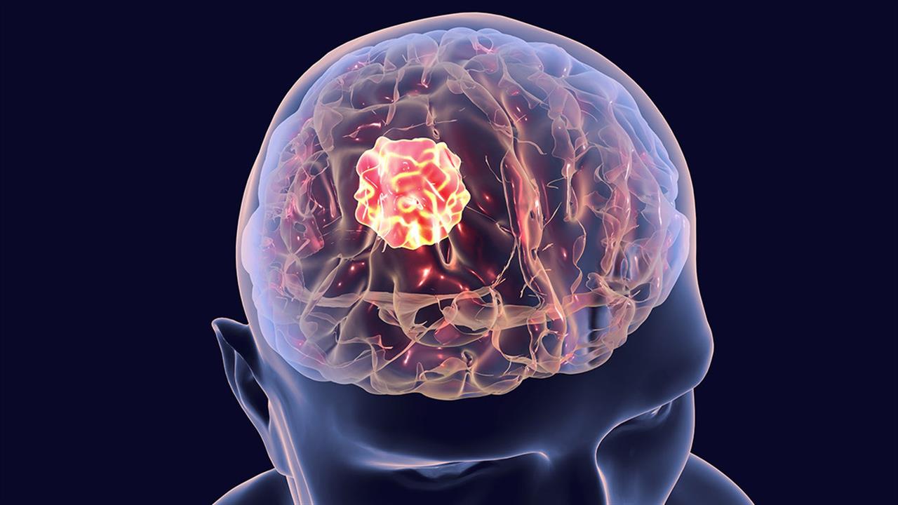 Όγκοι εγκεφάλου: Τι προσφέρει η τεχνολογία ανοσοφθορισμού