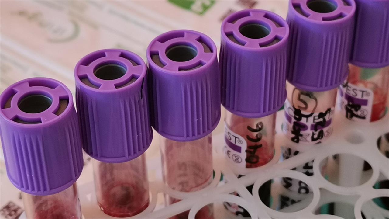 Εγκρίθηκε στην Αμερική η πρώτη γονιδιακή θεραπεία για ασθενείς με θαλασσαιμία