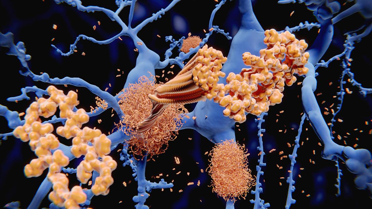 Οι  δύο φάσεις της εξέλιξης της νόσου Alzheimer