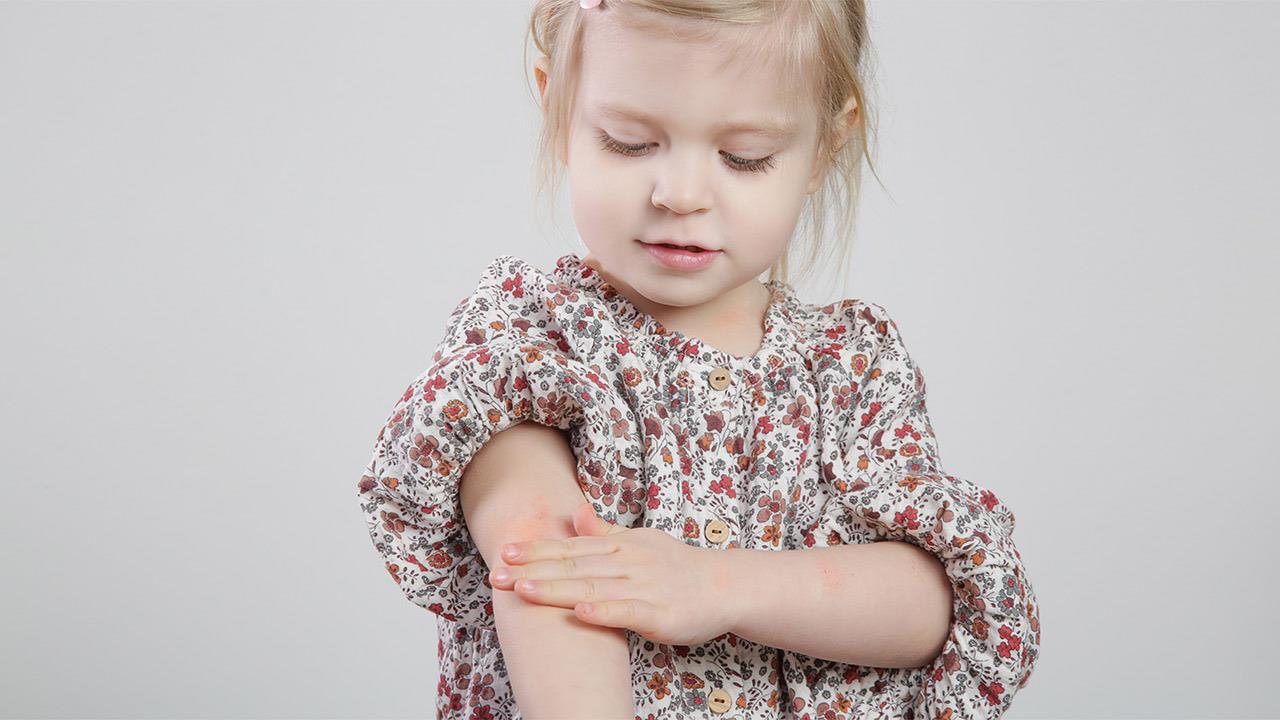 Η ατοπική δερματίτιδα στα παιδιά αυξάνει τον κίνδυνο κατάγματος