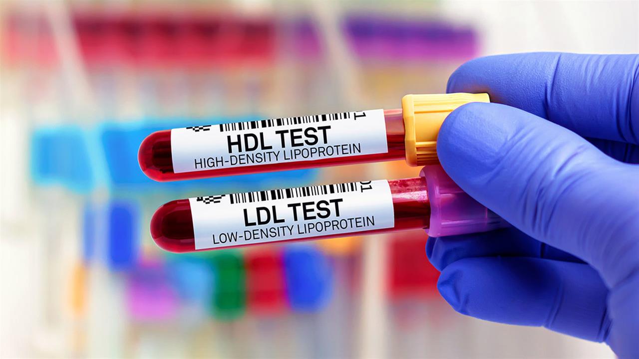 Υψηλότερη και χαμηλότερη χοληστερόλη HDL μπορεί να συνδέονται με αυξημένο κίνδυνο άνοιας [μελέτη]