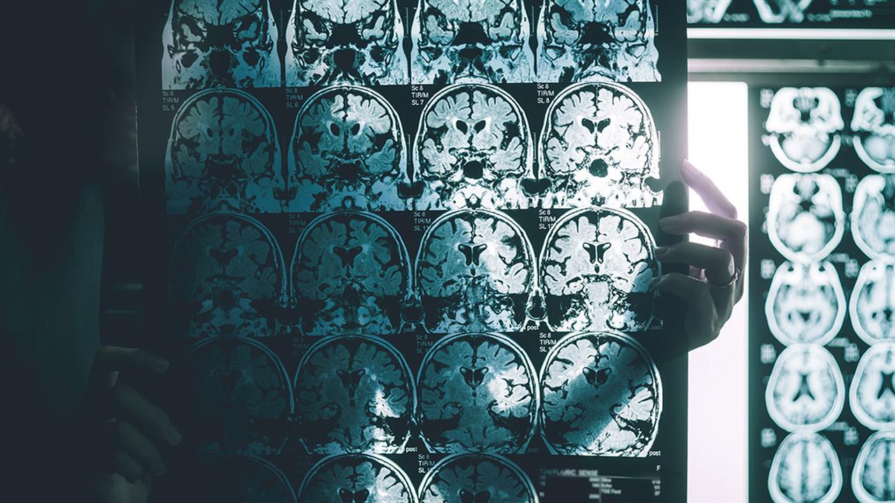 Ποιο κέντρο του εγκεφάλου προβλέπει τη γνωστική εξασθένηση [μελέτη]