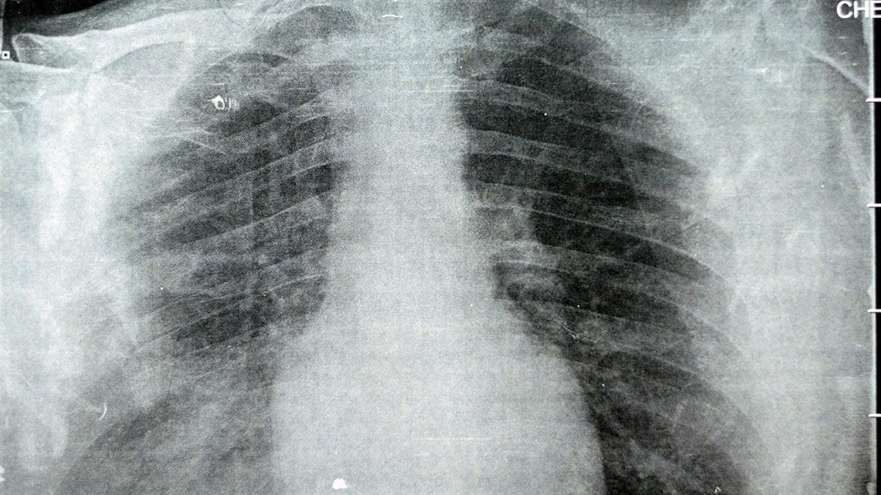 The Lancet: Γιατί η πνευμονία από μυκόπλασμα είναι σε έξαρση μετά την πανδημία