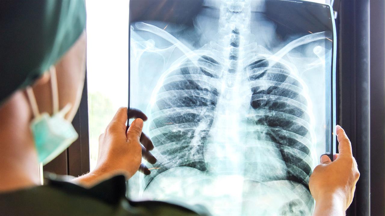H έγκαιρη ανακάλυψη του καρκίνου του πνεύμονα αυξάνει κατά 80% το 20ετές ποσοστό επιβίωσης [μελέτη]
