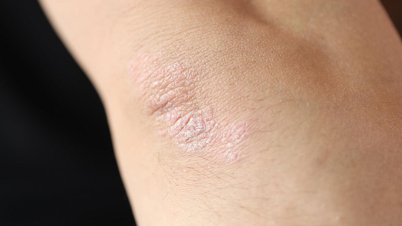 Χλώριο, αλάτι και ήλιος: Πώς επιδρούν στην ψωρίαση