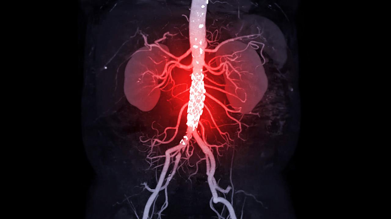 Γιατί χρειάζομαι επέμβαση καρδιάς ενώ δεν έχω κανένα σύμπτωμα