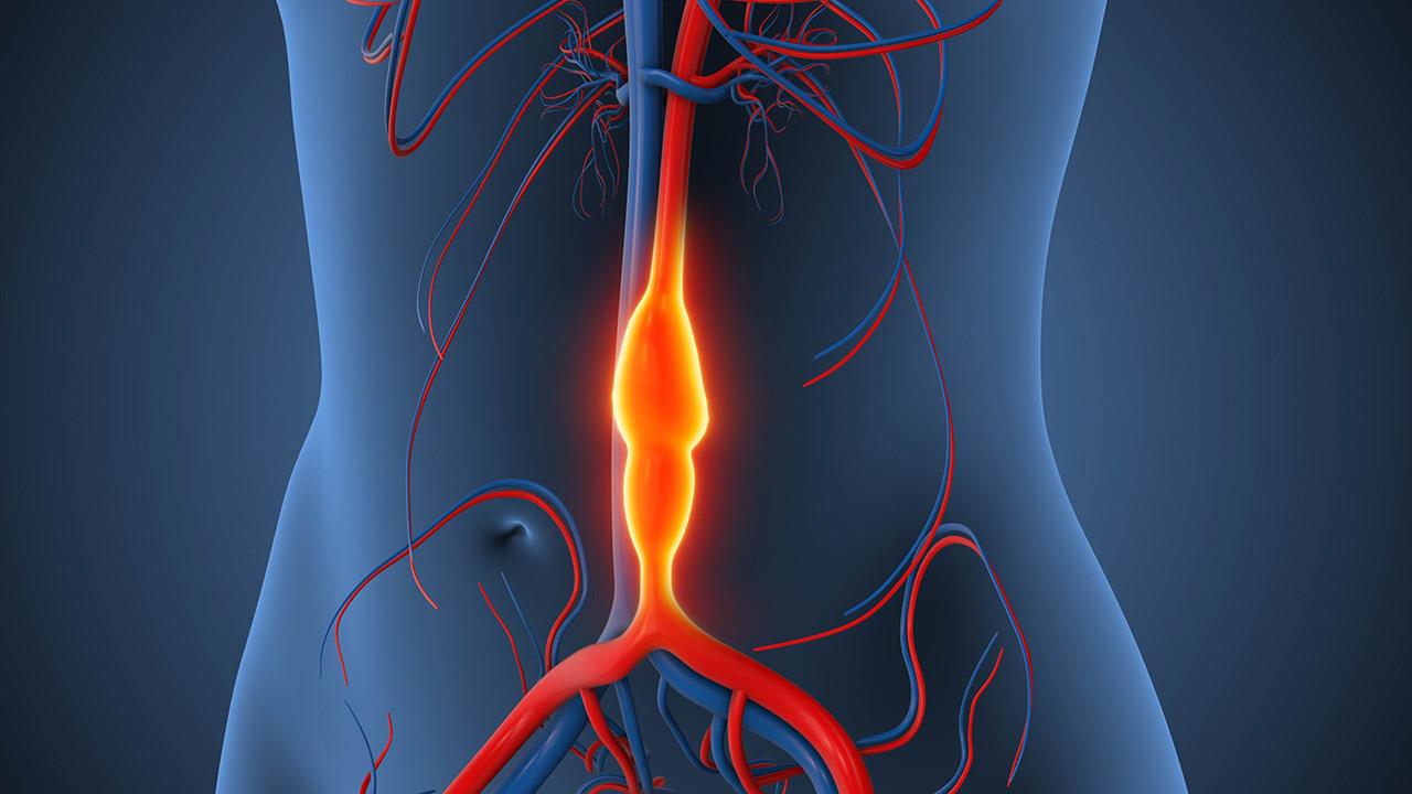 Ανεύρυσμα κοιλιακής αορτής: Παράγοντες κινδύνου, συμπτώματα και θεραπεία