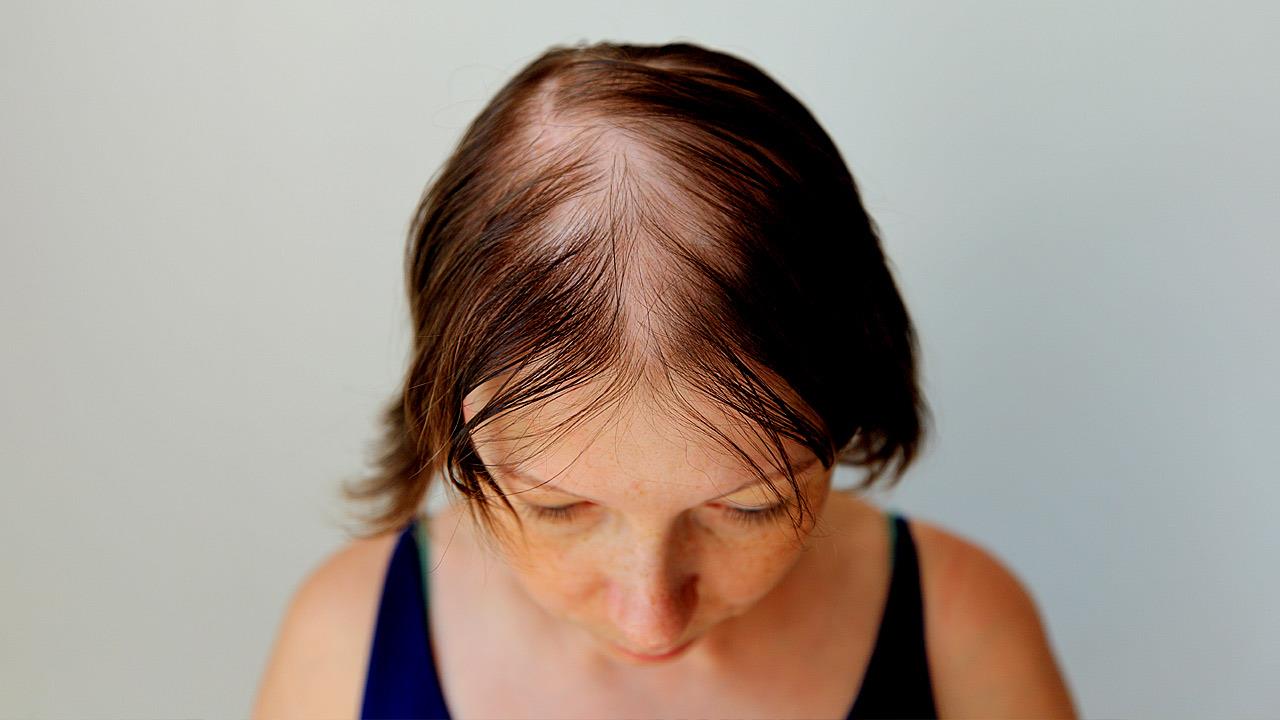 Μπορεί το στρες να προκαλέσει τριχόπτωση;