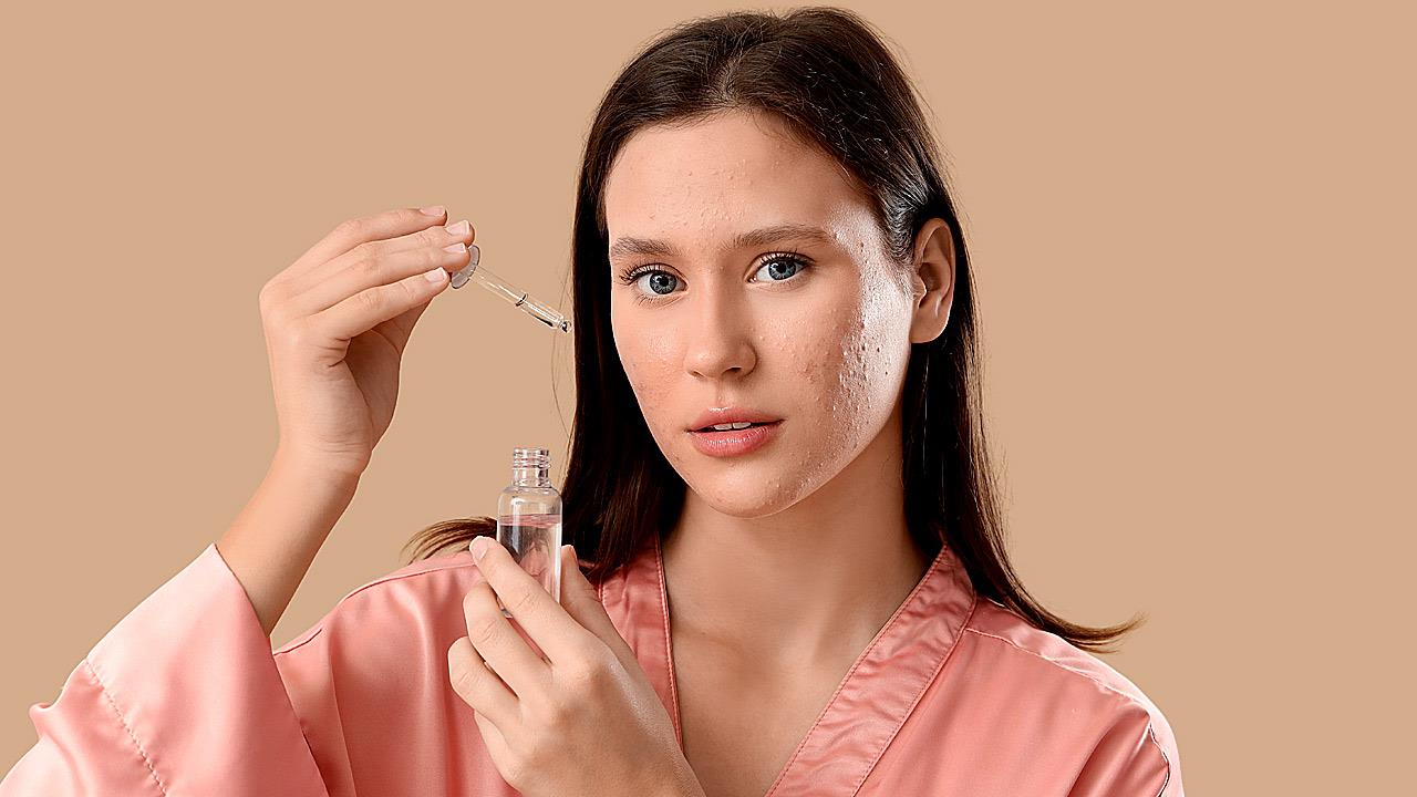 Αντιμετώπιση ακμής: Πώς η ρετινόλη μεταμορφώνει την επιδερμίδα σας