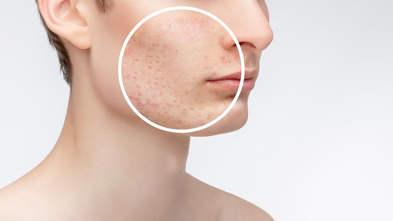 Τι προκαλεί ακμή γύρω από το στόμα;