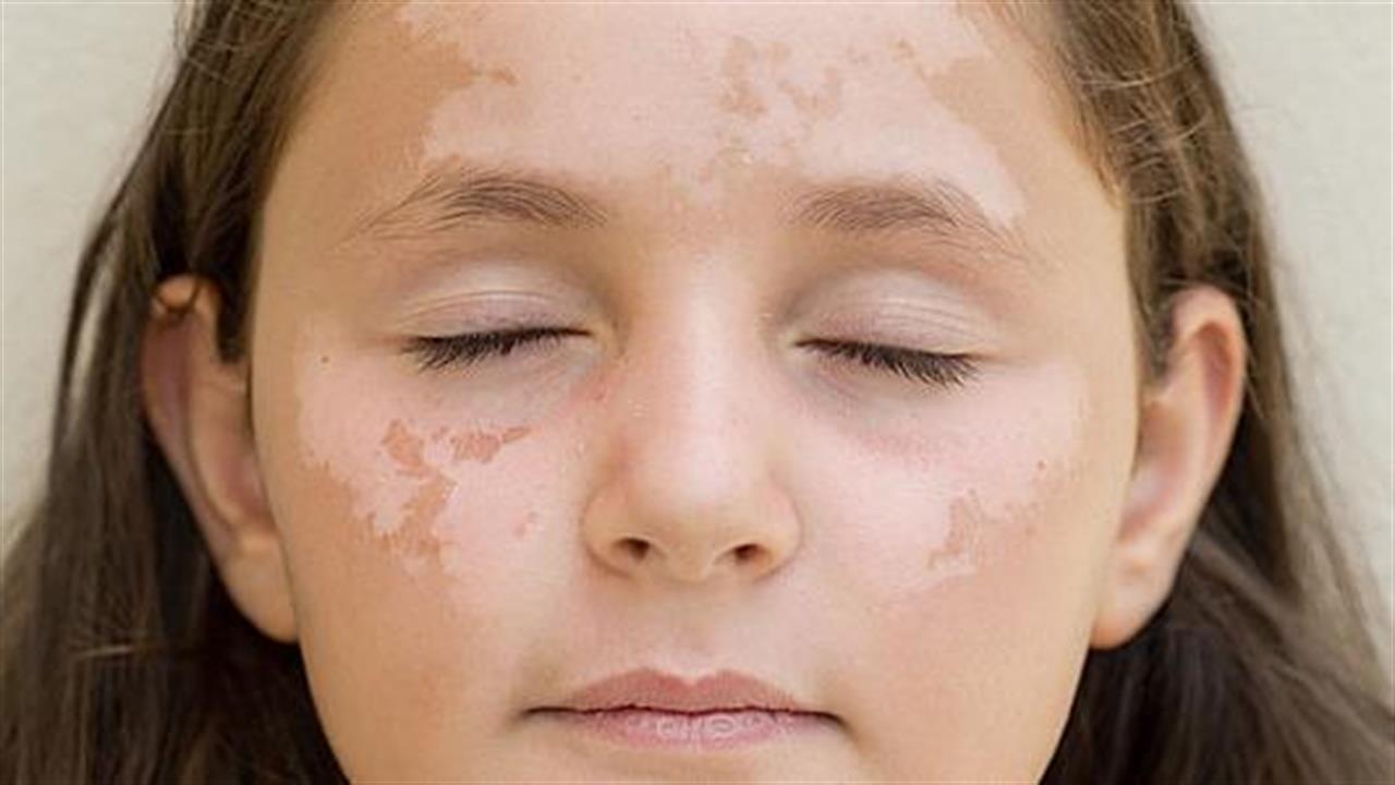 Ποιες παθήσεις του δέρματος επιδεινώνονται από τον ήλιο