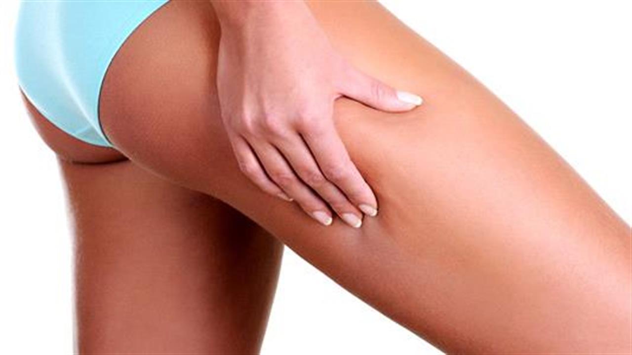 Απαλλαγείτε από την κυτταρίτιδα με απλές λύσεις