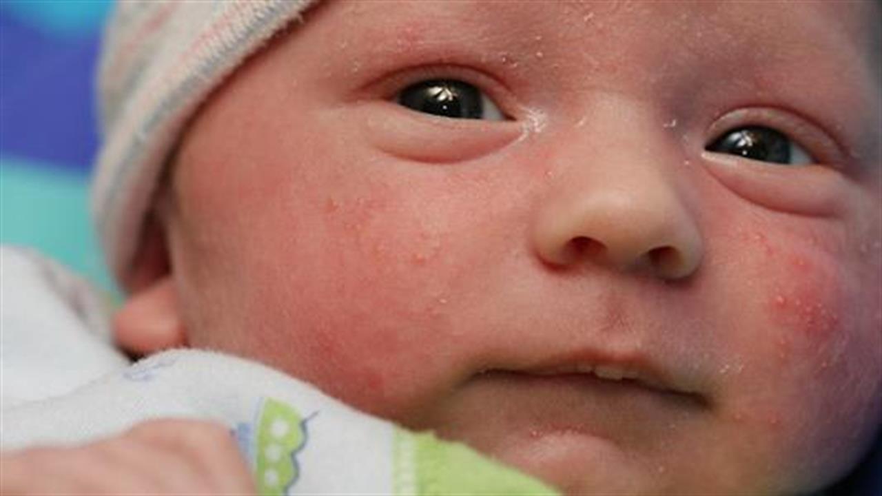 Το δέρμα του νεογέννητου και συχνές παθήσεις