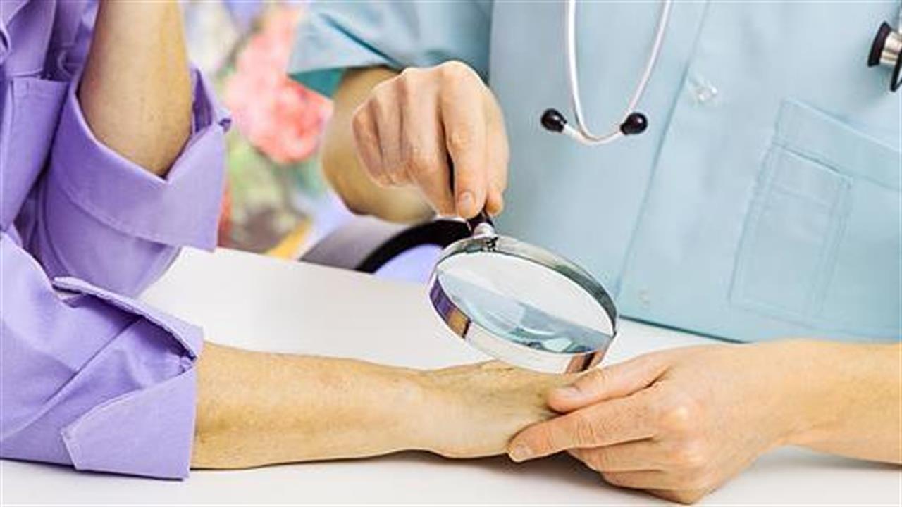 Ο FDA εγκρίνει το cemiplimab-rwlc για το προχωρημένο  πλακώδες καρκίνωμα του δέρματος