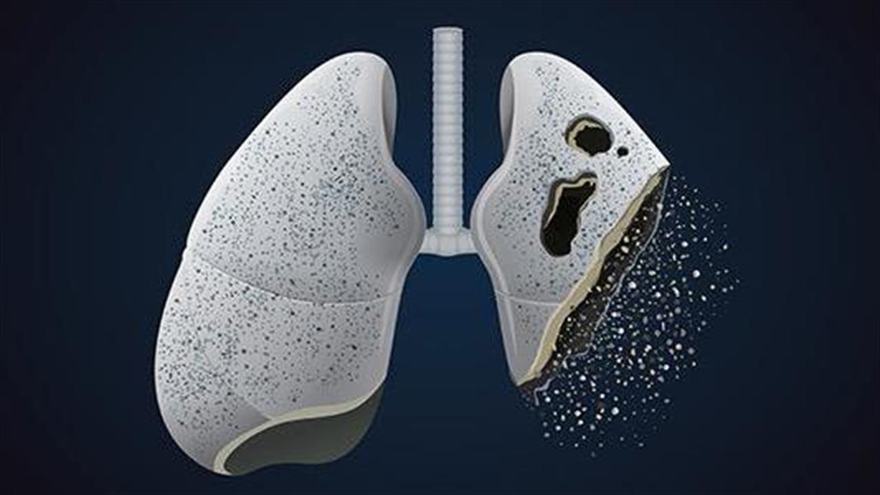 Ανοσοθεραπεία: Tο τελευταίο όπλο της ιατρικής επιστήμης στον αγώνα κατά του καρκίνου του πνεύμονα