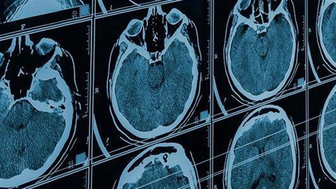 Νευρολογικές εκδηλώσεις και επιπτώσεις στις υπηρεσίας υγείας των νευρολογικών ασθενών κατά τη διάρκεια της πανδημίας