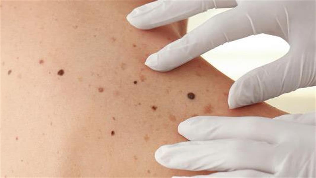 Η ανάγκη ένταξης του καρκίνου του δέρματος στις επαγγελματικές ασθένειες