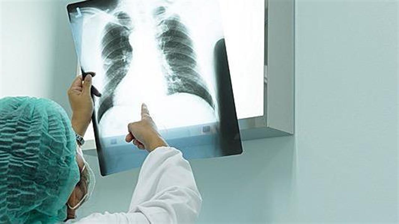 Η MSD στηρίζει το προτεινόμενο Σχέδιο Δράσης για τον καρκίνο του πνεύμονα