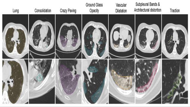 Μελέτη του Ινστιτούτου Humanitas για τη βοήθεια της τεχνητής νοημοσύνης στην COVID-19