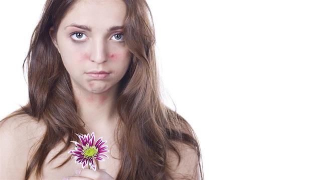 Ακμή: Τι να προσέξετε την άνοιξη