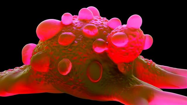 Καρκίνος ουροδόχου κύστης: Η ανοσοθεραπεία μειώνει ενδεχομένως την υποτροπή