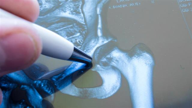 Αρθροπλαστική ισχίου: Ποιες οι προϋποθέσεις για την επιτυχία της;