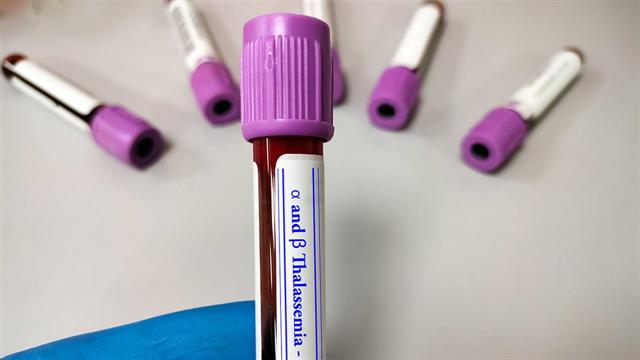 Θετική γνωμοδότηση από τον ΕΜΑ ως προς τη γονιδιακή θεραπεία για τη β-θαλασσαιμία