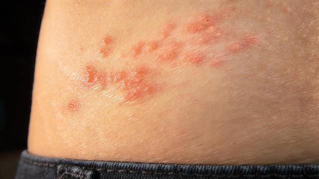 Ο έρπης ζωστήρας ενεργοποιείται μετά από σοβαρή νόσηση από κορωνοϊό